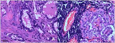 Clinicopathological features of two cases of ETV6-NTRK3 rearranged papillary thyroid carcinoma: a case report